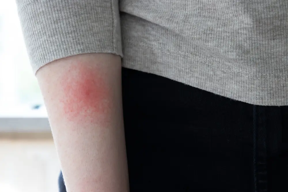Tick Bites & Lyme Disease in NH