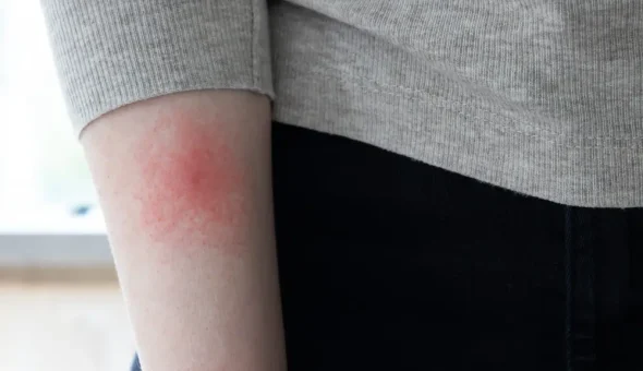 Tick Bites & Lyme Disease in NH